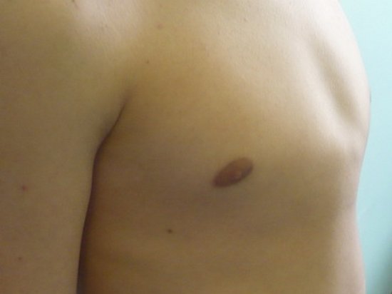 Килевидная деформация грудной клетки