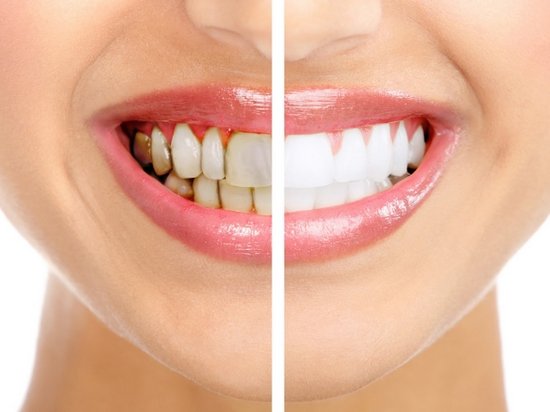 Зубной камень: причины, последствия и способы очистки