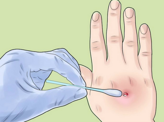 Как лечить стафилококк