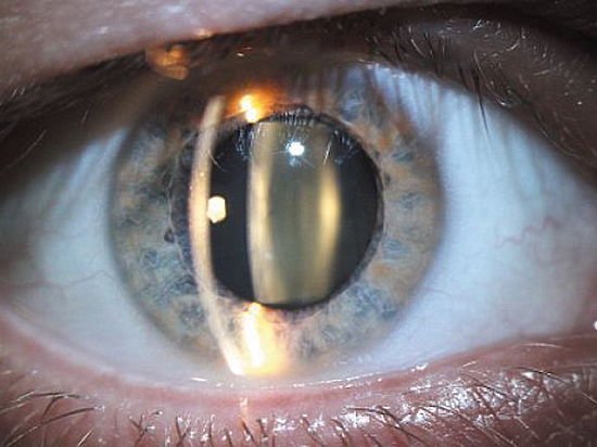 Лечение катаракты современными методами