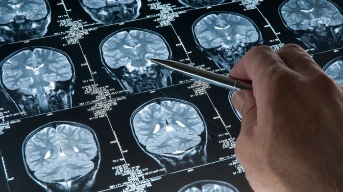 10 симптомов, причиной которых может быть опухоль мозга