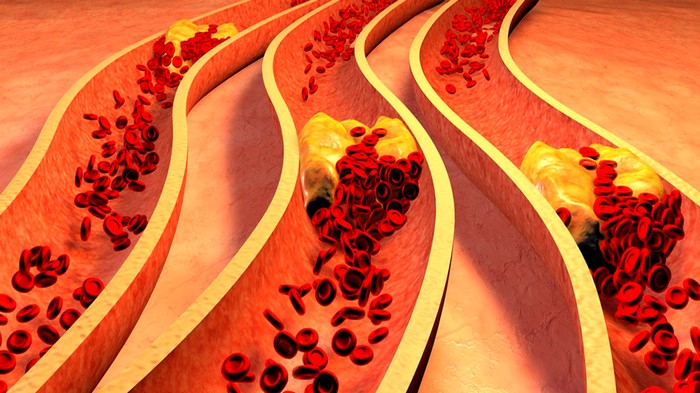 7 эффективных способов очищения артерий естественным путем