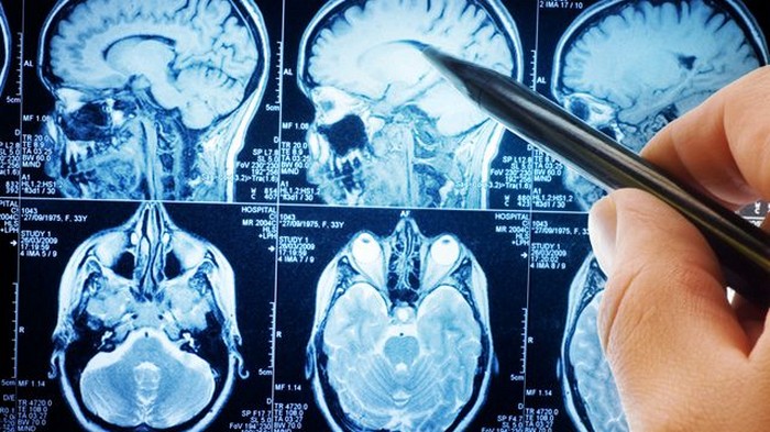 Опухоль головного мозга: 13 тревожных признаков и симптомов