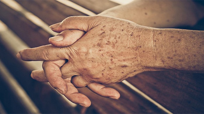 Темные пятна на руках пожилых людей: откуда появляются и можно ли от них избавиться