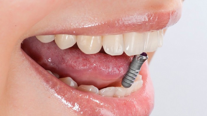 Почему люди выбирают имплантацию зубов