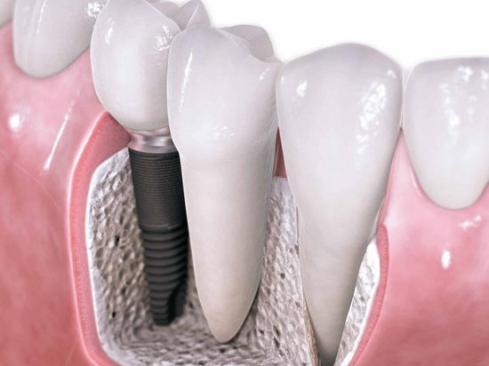 Имплантация зубов – все тонкости процедуры
