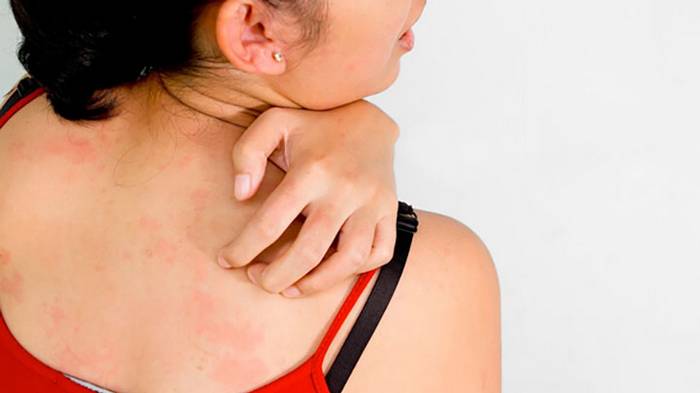 Стресс может вызвать сыпь на коже: как правильно ее лечить