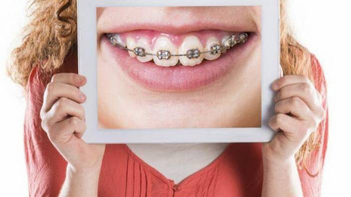 Ортодонтия — что это и как ее лечить