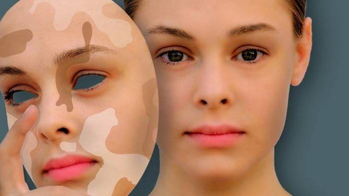 Известный дерматолог показал, как вывести коричневые пятна на коже лица и тела