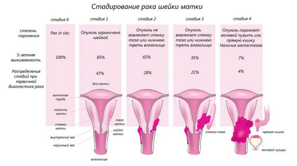 стадирование рака шейки матки
