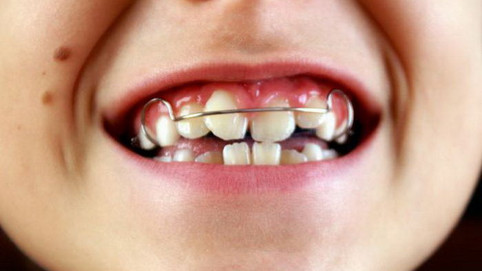 Особенности прикуса у детей: как исправить прикус ортодонтическими пластинами отвечает детский ортодонт стоматологии «Улыбнись»