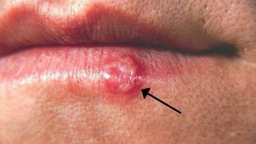 Вирус герпеса — не просто легкая кожная болезнь