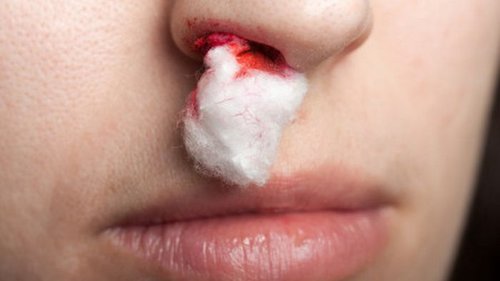 6 приемов, которые помогут быстро остановить кровотечение из носа