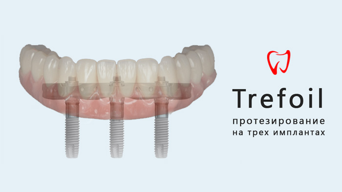 Восстановление зубов на челюсти с помощью трех имплантов и метода Trefoil: возможности и особенности технологии
