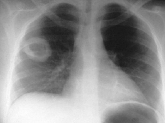 Кавернозный туберкулез – симптомы и лечение