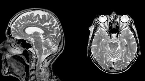 Когда назначают МРТ головного мозга и что она показывает?