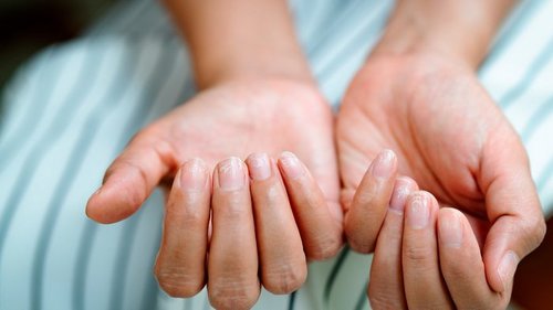 Меланома ногтя: симптомы опасного заболевания, которые нельзя пропустить