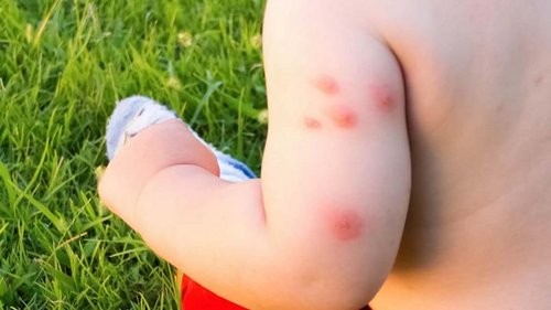 3 натуральных средства, которые быстро снимут зуд от комариного укуса