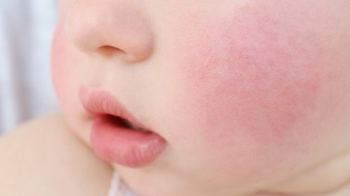 Пищевая аллергия у детей: симптомы и лечение