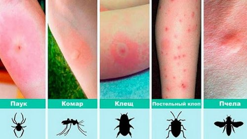 Двенадцать простых способов избавиться от укусов насекомых