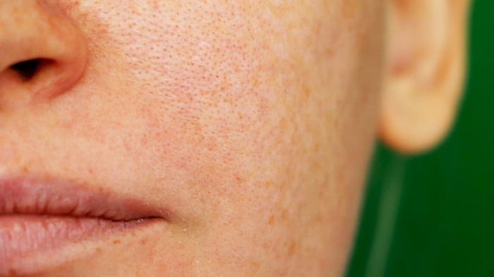 Как сузить поры на лице, на носу? средства для расширенных пор и чистки лица