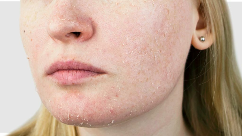 Шелушение кожи на лице: причины