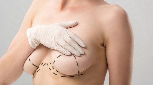 Хирургическая подтяжка груди: важные особенности