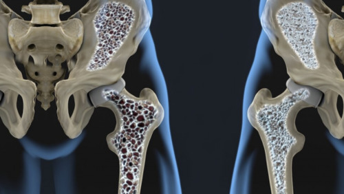 Чем опасен остеопороз? Профилактика остеопороза