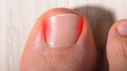 Как решить проблему вросших ногтей