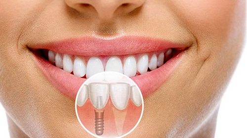 Особенности подготовки к одномоментной имплантации зубов
