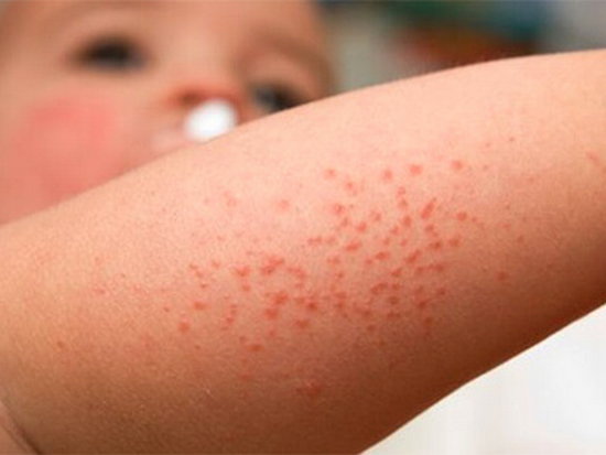 Аллергия на антибиотики — симптомы и лечение