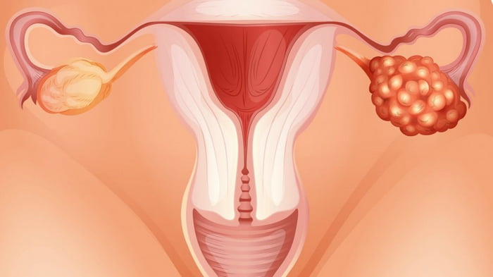 Чем опасно появление кисты яичника при беременности?