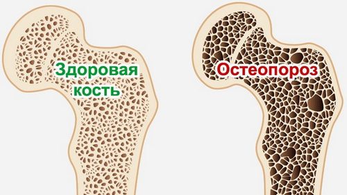 Лечение остеопороза в клинике Таргет