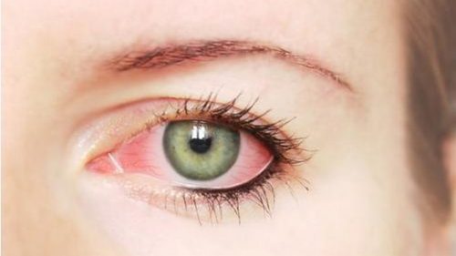 Как бороться с покраснением глаз?