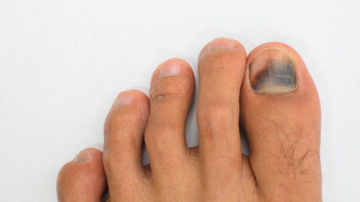 Черные ногти: как лечить почернения на ногтевых пластинах?