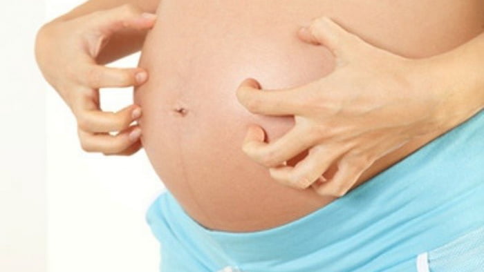 Псориаз губительно влияет на беременность