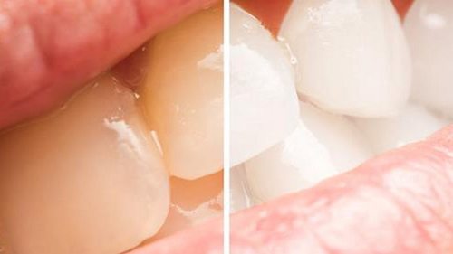 5 простых способов отбеливания желтые зубов натуральным способом