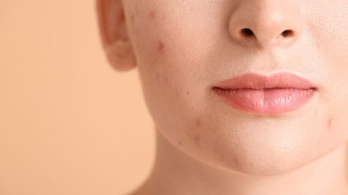 Как лечить проблемную кожу лица