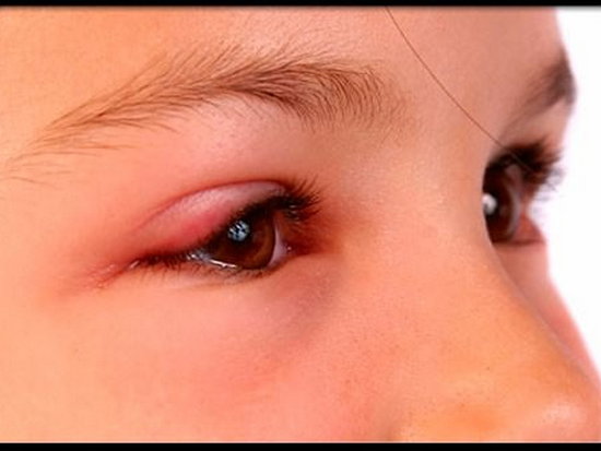 Аллергия на глазах – симптомы и лечение