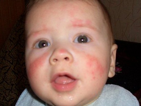 Аллергия у детей – симптомы и лечение