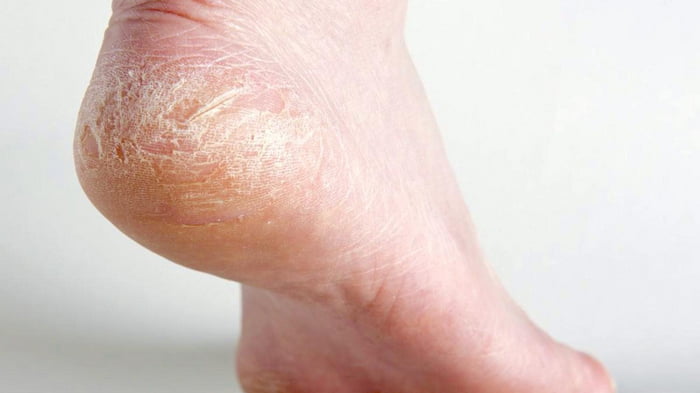 Причины шелушения кожи на стопах и меры предотвращения