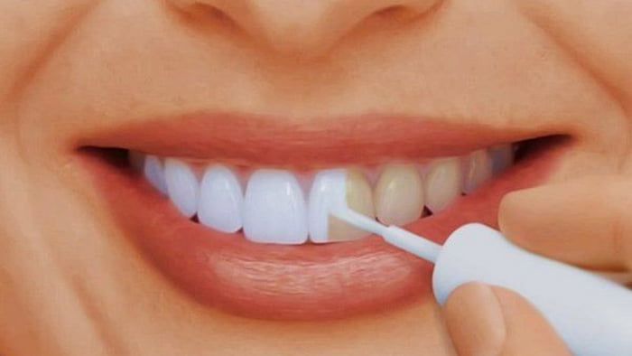 Как правильно отбеливать зубы?