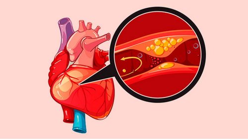 Что такое ишемическая болезнь сердца? Каковы симптомы?