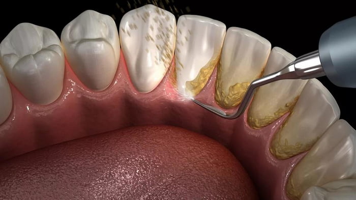 Способы удаления зубного камня. Безопасные методы