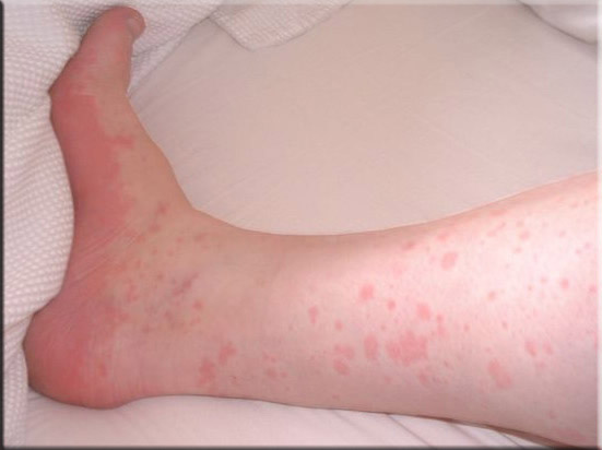 Аллергия на холод: симптомы и лечение