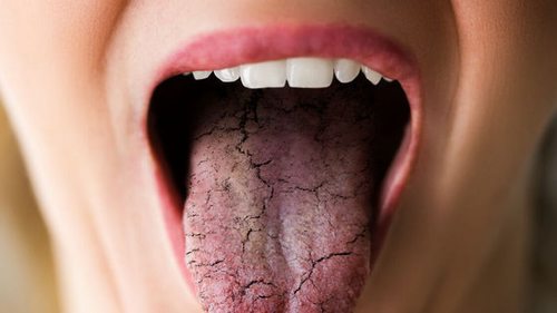 Может быть симптомом пяти серьезных заболеваний: почему нельзя игнорировать сухость во рту