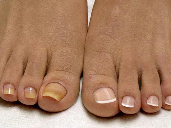 Грибок на ногтях: профилактика и способы лечения