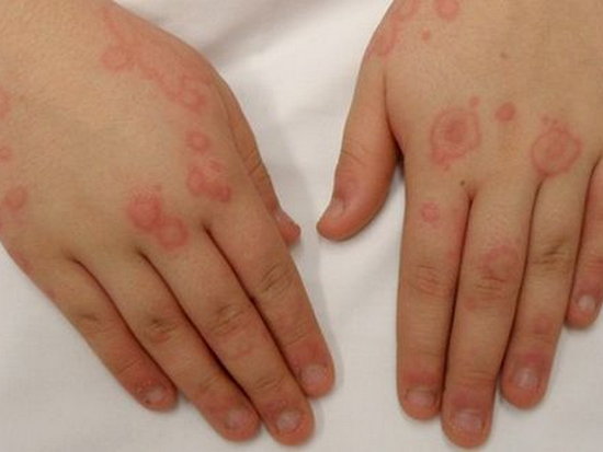 Аллергия на холод на руках и лице