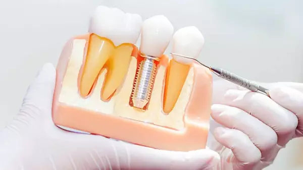 Имплантация верхних зубов: все, что вам нужно знать