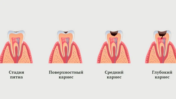 стадии кариеса